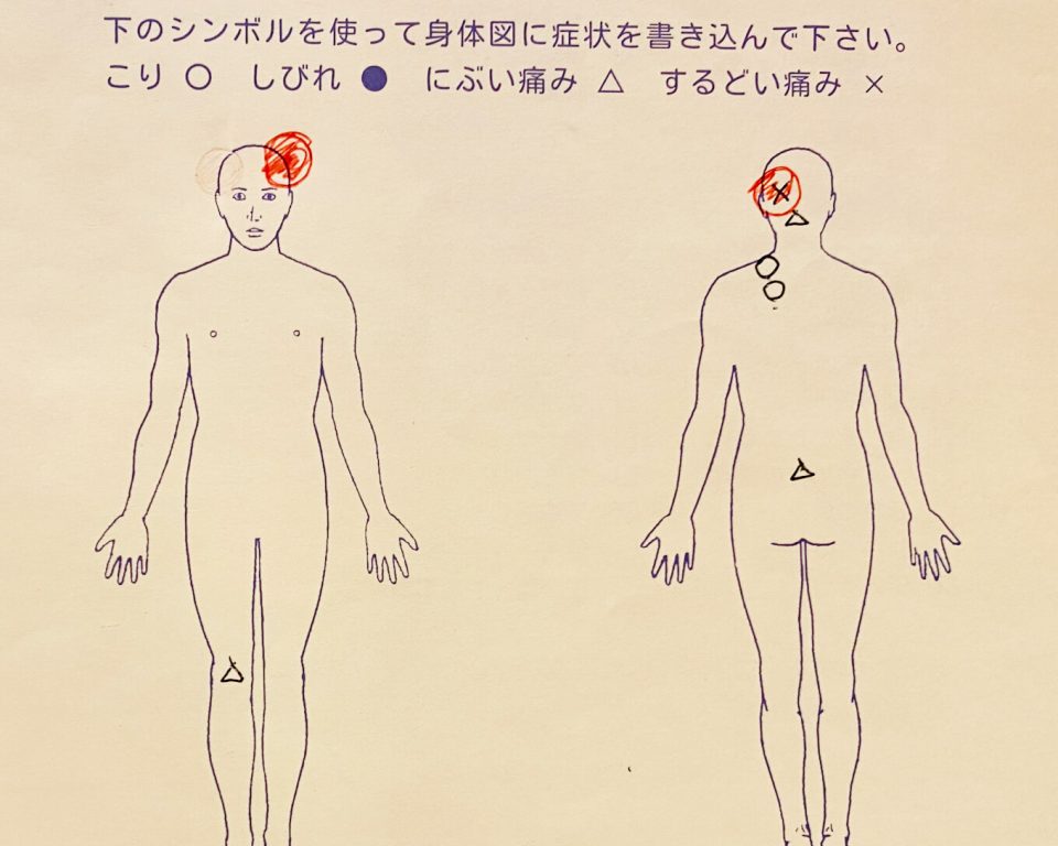 群発頭痛の症例 左目の奥が痛い